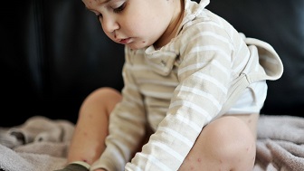 Ein Kleinkind sitzt und schaut auf den Boden. An den Beinen des Kindes sind rote Stellen und Pusteln zu erkennen. 